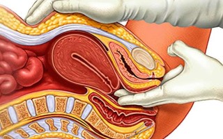 多囊卵巢综合征 (PCOS)诊断