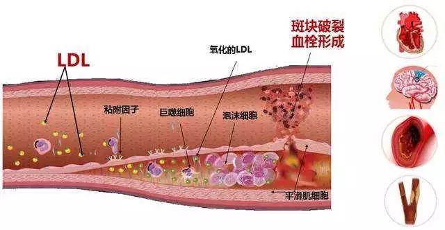 血栓竟然长这样，吓人！让血栓不上身的方法就一个字…-第5张图片-爱来健康