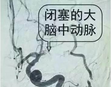 血栓竟然长这样，吓人！让血栓不上身的方法就一个字…-第3张图片-爱来健康