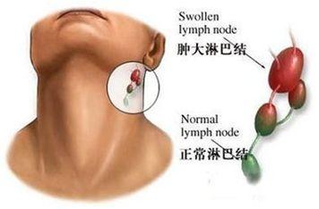 肺癌、肝癌、胃癌、大肠癌、乳腺癌、甲状腺癌等14种恶性肿瘤筛查与预防指南！-第10张图片-爱来健康