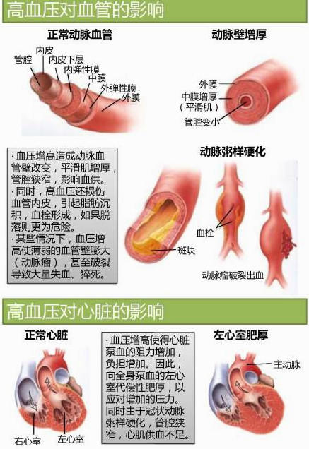 15张高血压医学美图，一文搞定高血压！-第5张图片-爱来健康