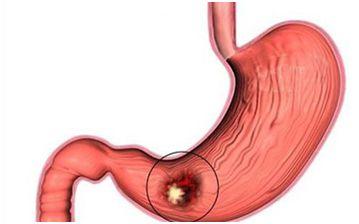 肺癌、肝癌、胃癌、大肠癌、乳腺癌、甲状腺癌等14种恶性肿瘤筛查与预防指南！-第7张图片-爱来健康