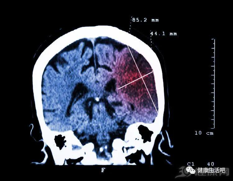 神经内科专家：脑梗发作2个月前，身体就有预兆，很多人都忽视了-第1张图片-爱来健康