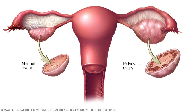 多囊卵巢综合征 (PCOS)-第1张图片-爱来健康