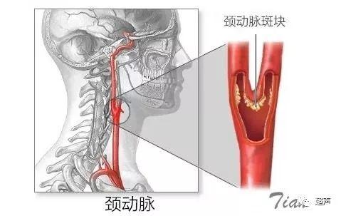 颈动脉斑块怎么治疗？-第5张图片-爱来健康