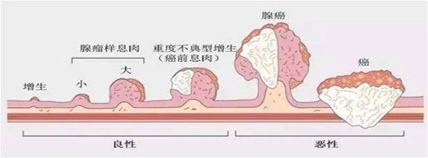 14个肠镜中13个有癌前病变，1个确诊肠癌！这22种情况必须查个肠镜！-第2张图片-爱来健康