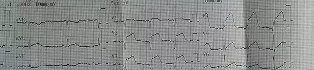 心内科医生整理的7个心梗教训，很多人都是被自己坑死的-第6张图片-爱来健康