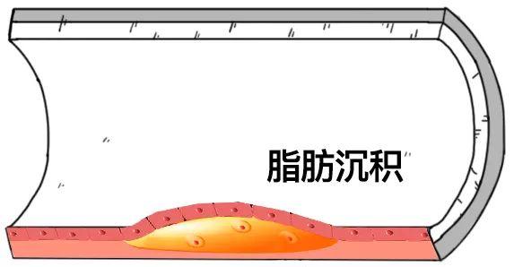 好好的血管，怎么就「堵」了？-第10张图片-爱来健康