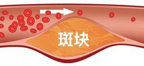 好好的血管，怎么就「堵」了？-第17张图片-爱来健康