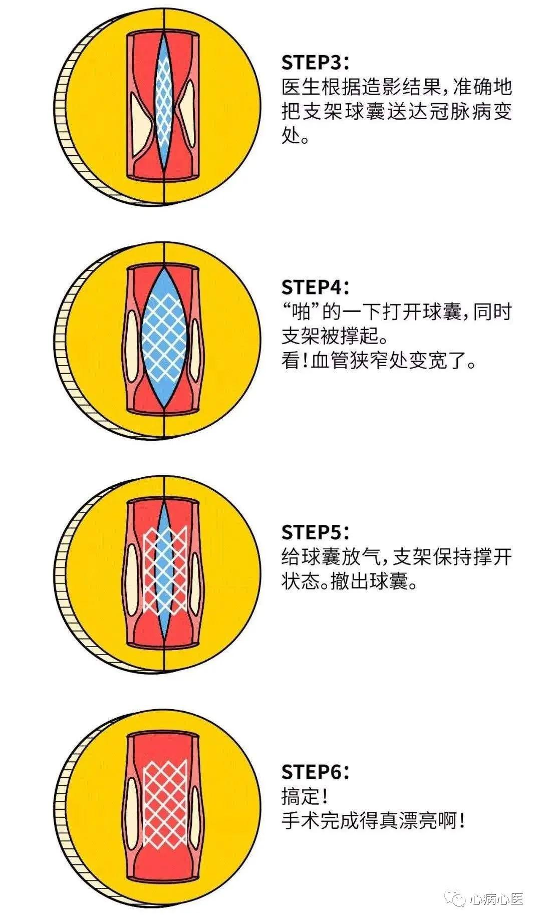 一台完整的PCI手术是如何完成的？-第5张图片-爱来健康