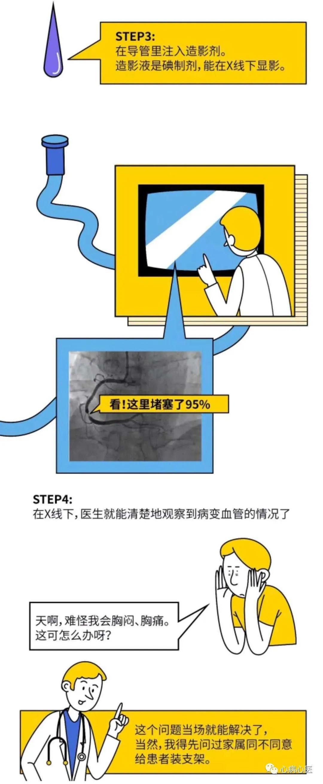 一台完整的PCI手术是如何完成的？-第3张图片-爱来健康