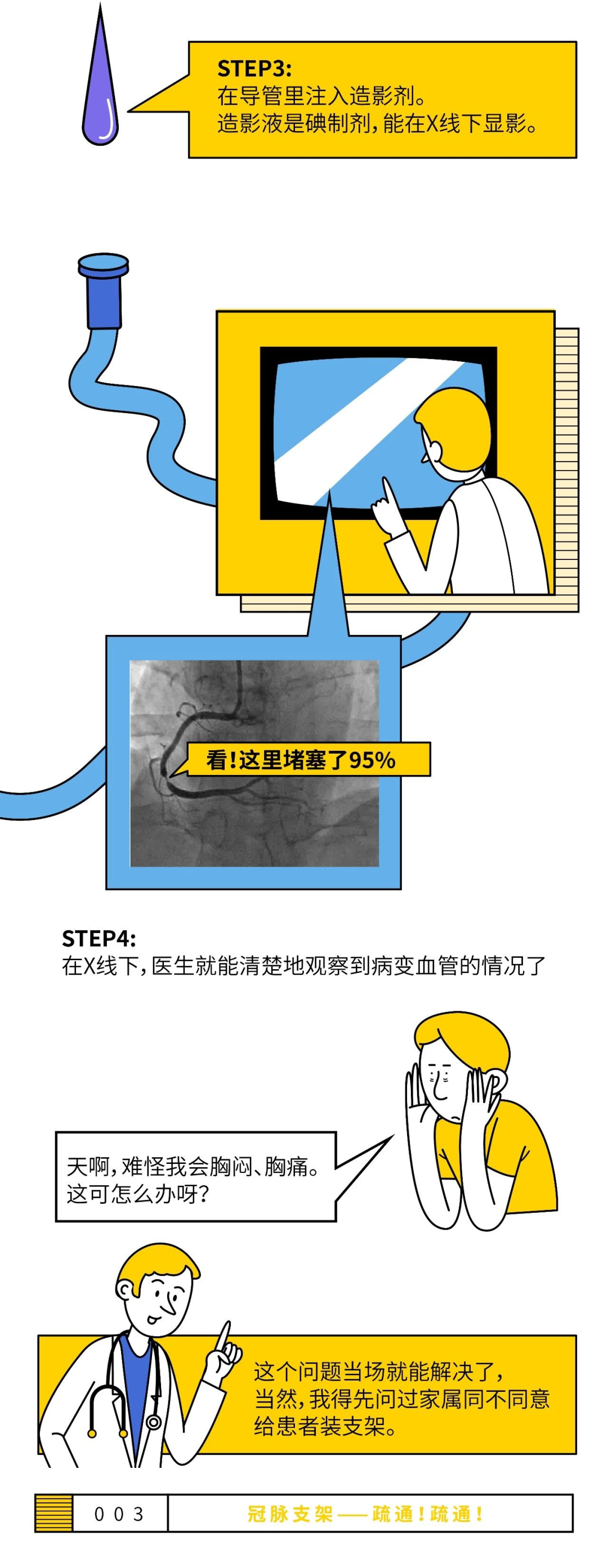 心脏支架是怎么装进去的？看完漫画你就全明白了-第3张图片-爱来健康