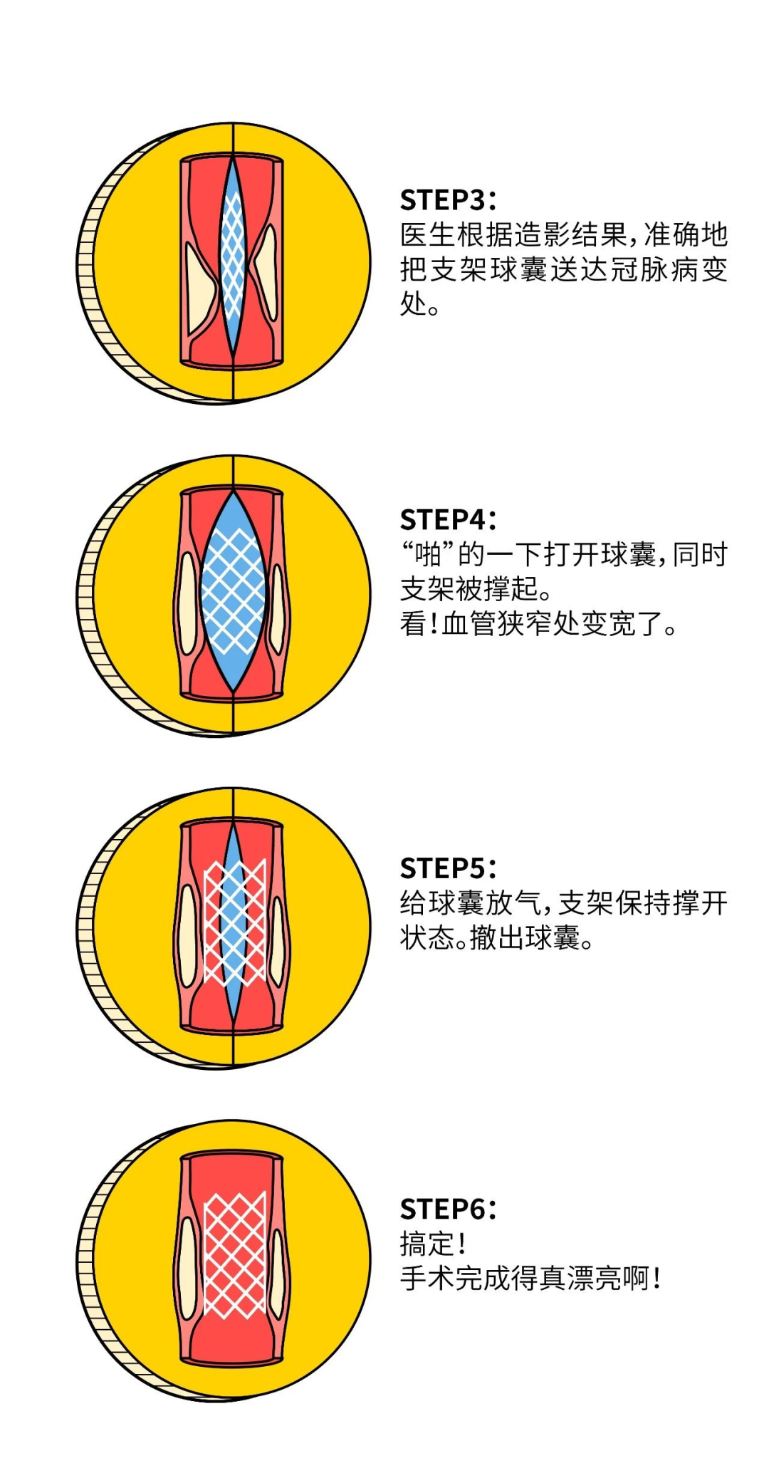 心脏支架是怎么装进去的？看完漫画你就全明白了-第5张图片-爱来健康