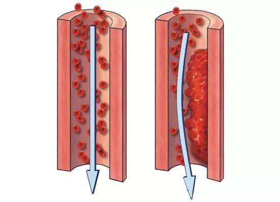 三位院士呼吁：99%的血栓无征兆，记住一个字，让你一生无栓-第6张图片-爱来健康