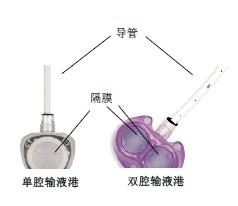 植入式输液港置入资料了解-第1张图片-爱来健康