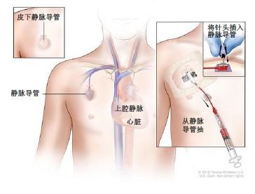 植入式输液港置入资料了解-第2张图片-爱来健康